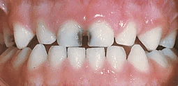 decay-in-baby-teeth